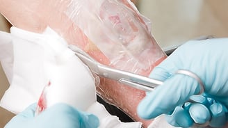 Moisture Management in Wound Care: Highlighting MVTR in Films